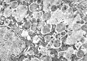 M,39y. | lymph node - metastasis of adenocarcinoma M,39y. | lymph node - metastasis of adenocarcinoma